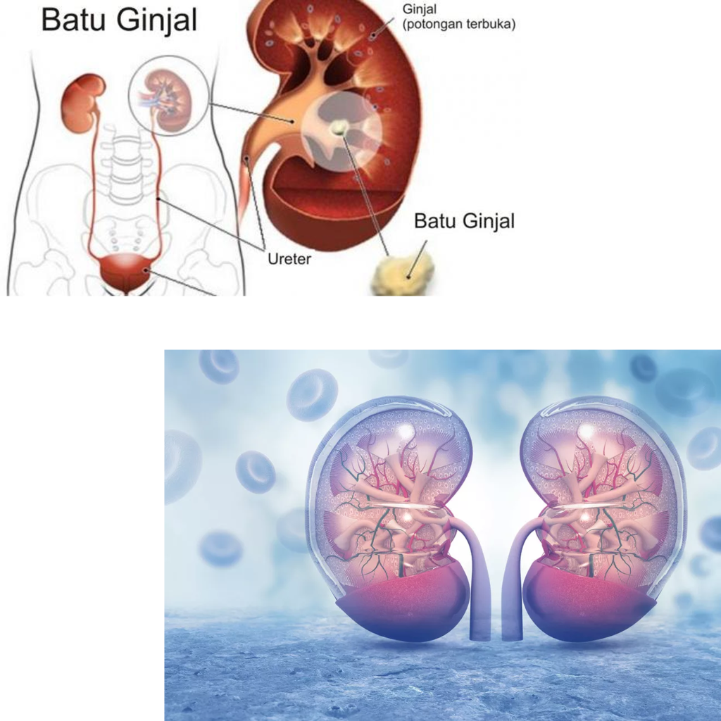 Batu ginjal