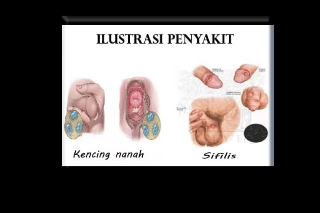 Sifilis Atau Raja Singa