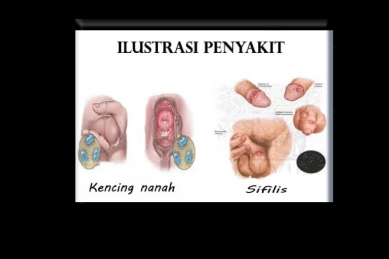 Sifilis Atau Raja Singa