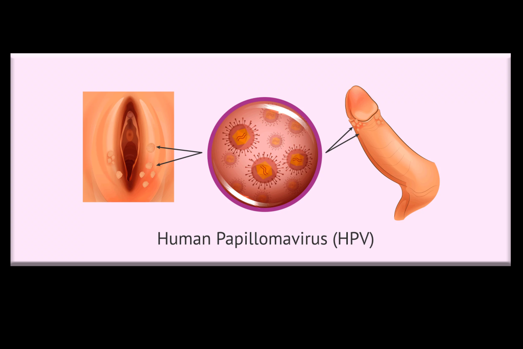 Kasus Gejala HPV